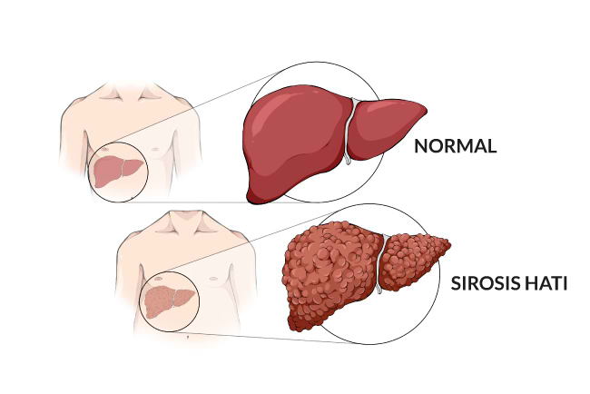 Gagal Hati: Ancaman Kerusakan Liver Dan Kunci Kesehatan Organ Vital